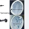 Бургаският неврохирург д-р Тодоров показа какво става с мозъка след падане с тротинетка: Не използвайте това превозно средство!